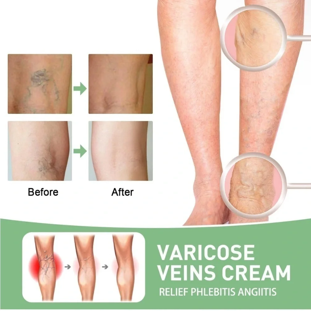 Varicose Veins Cream - Green Nourishing Leg Gel (50g) Lot Of 3 NEW